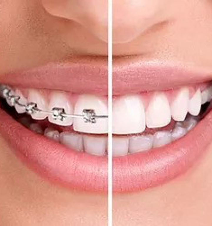 La
                        contention