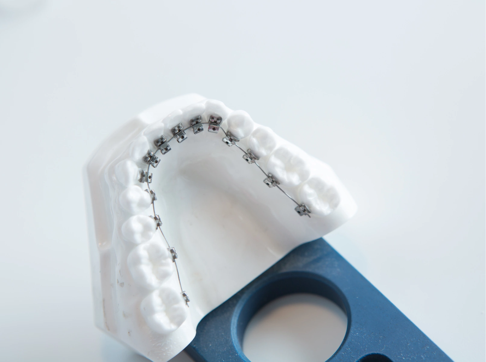 Orthodontie linguale sur mesure